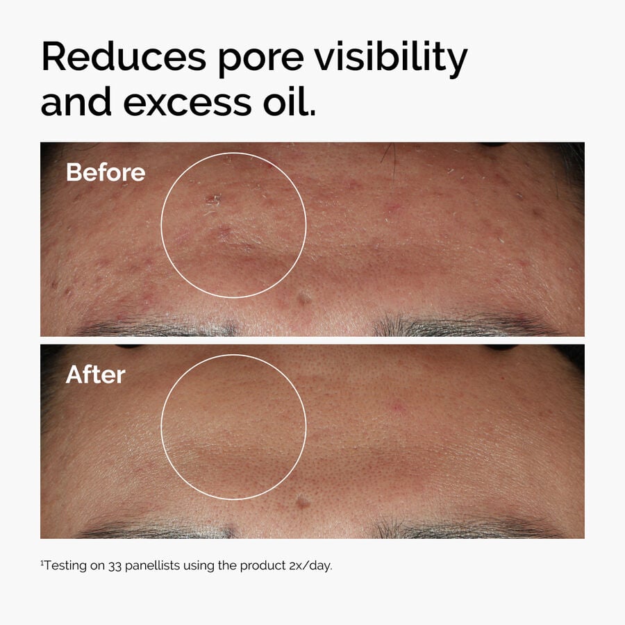 niacinamide-10-zinc-1-v2 ord-niacinamide-zinc-blemish-serum-before-after-pores.jpg