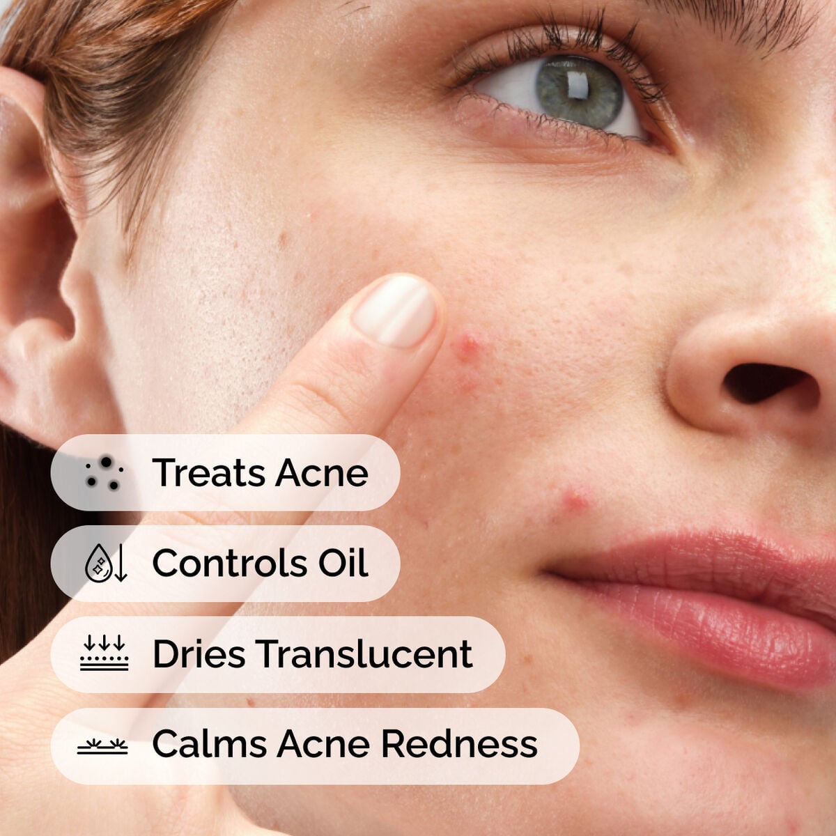 sulfur-10-powder-to-cream-concentrate-b7 ord-sulfur-10pct-powder-to-cream-concentrate-model-application-with-benefits-acne.jpg
